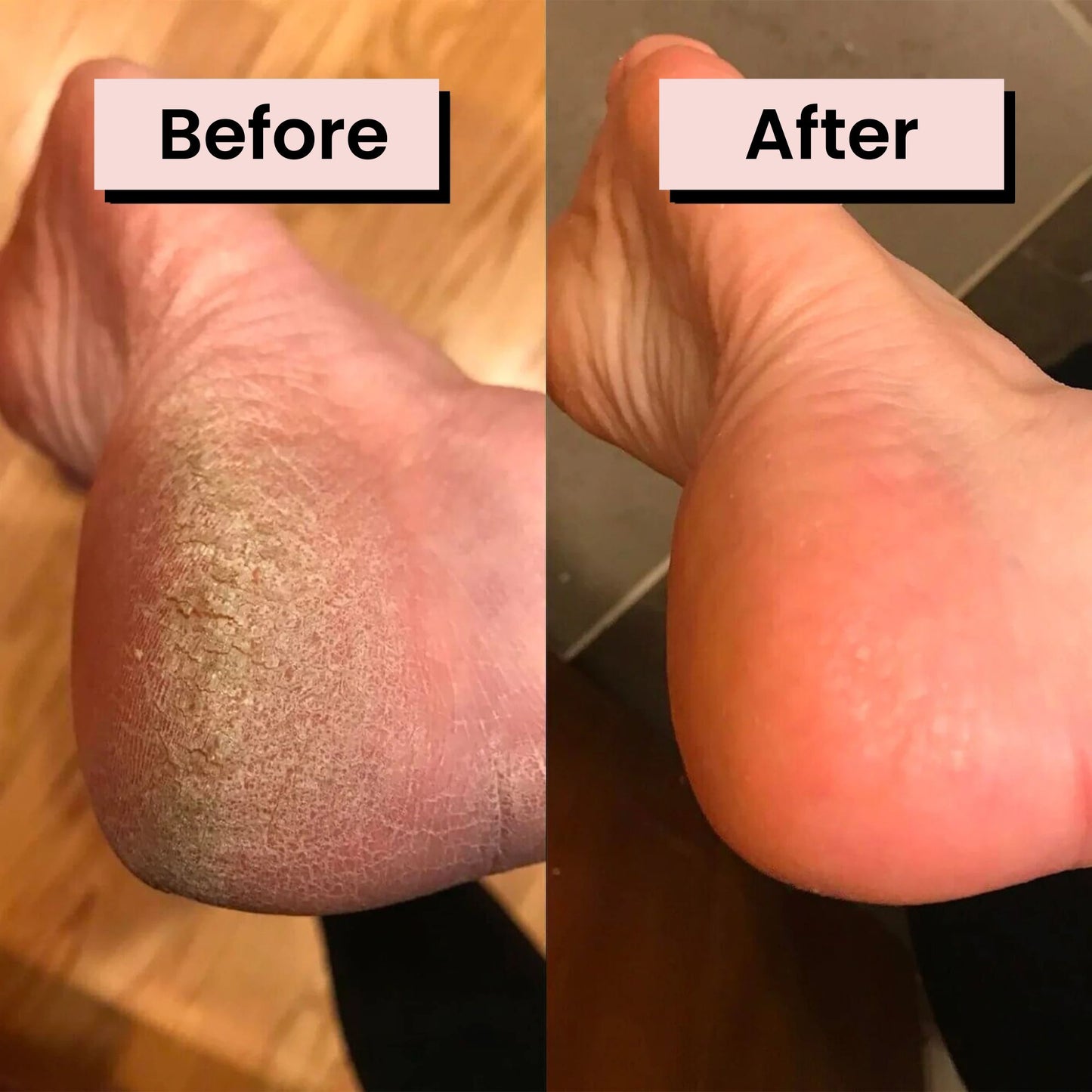 Pedicuure™: Automatic Callus Remover